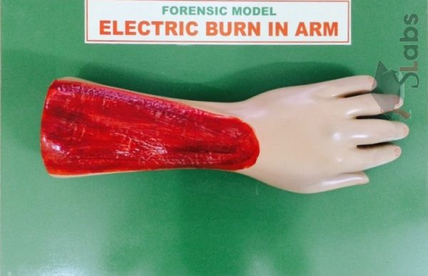 Electric Burn In Arm
