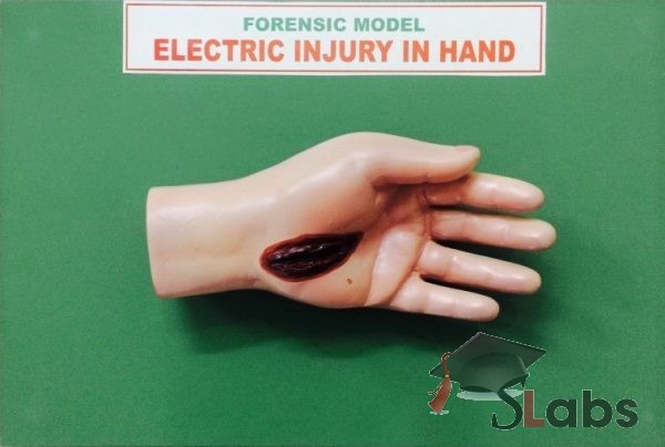 Electric Injury In Hand